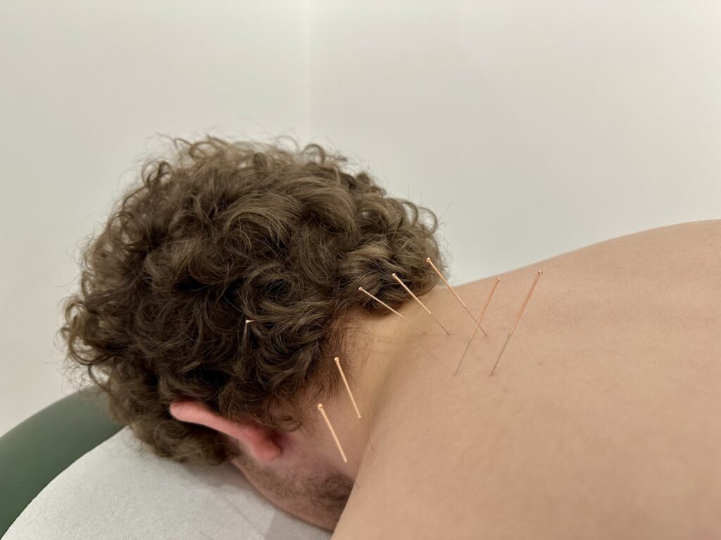 York Acupuncture at Acomb Chiropractic clinic. Local York Chiropractor Jonathan Brack demonstrates acupuncture to the neck and shoulder on a male, for neck and shoulder pain