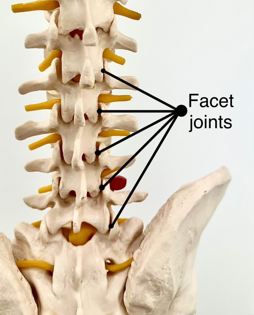 Picture showing the anatomy of the facet joints in the lumbar spine (the lower back), irritation in these joints can cause facet joint pain.